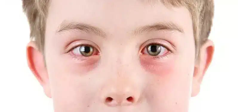 Eye Allergies in Monterey & Seaside, CA