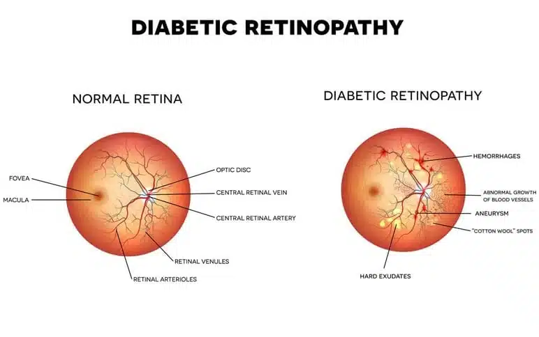 Diabetic Retinopathy in Monterey & Seaside, CA