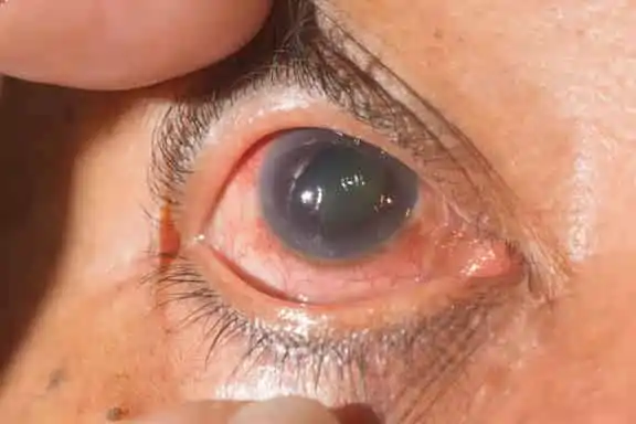 Glaucoma in Monterey & Seaside, CA